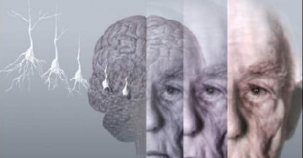 Билл Гейтс инвестировал $30 млн в изучение болезни Альцгеймера