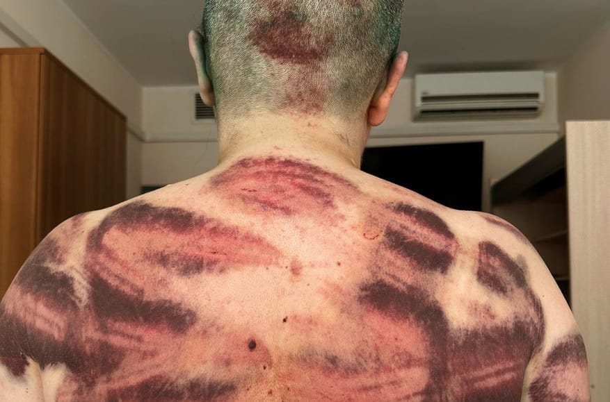 Fractures, bruises, and traumatic brain injury: Moscow clinic examines journalist Elena Milashina, victim of July 4 assault in Chechnya