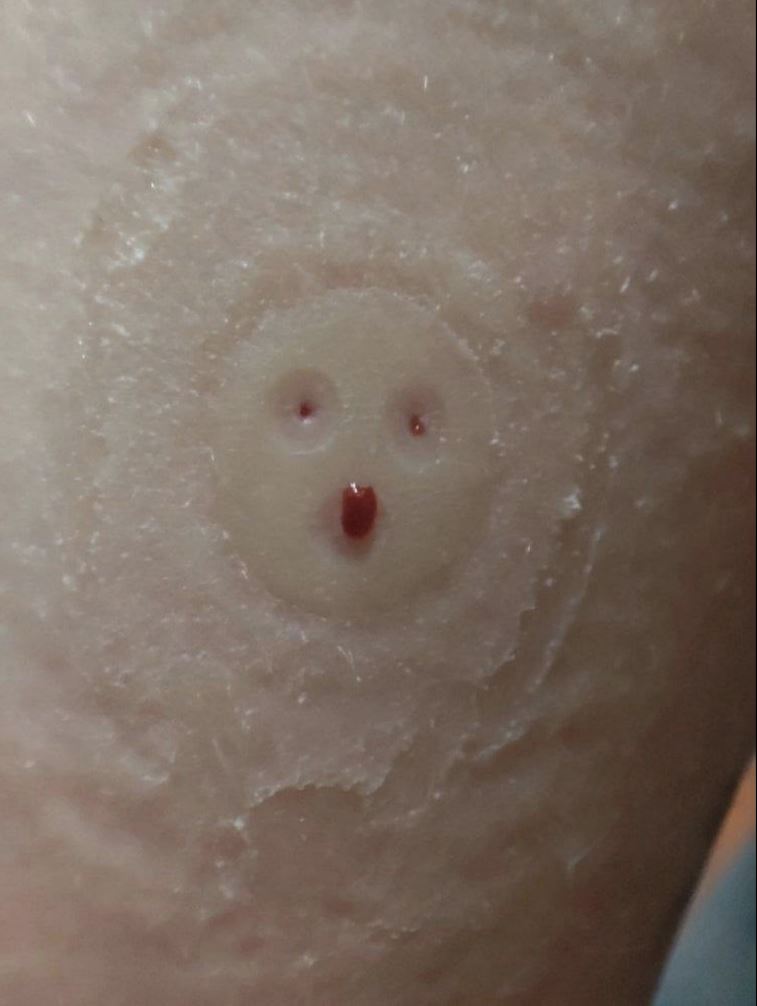 A photo of a child’s arm right after the removal the new Chinese continuous glucose monitor (Dr. Brinner) which shows the impact of the “three iron nails.”